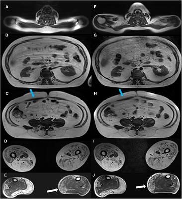 Quantitative Muscle MRI as Outcome Measure in Patients With Becker Muscular Dystrophy—A 1-Year Follow-Up Study